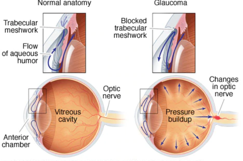 Signs of Glaucoma