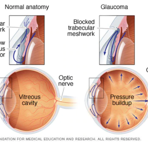 Signs of Glaucoma